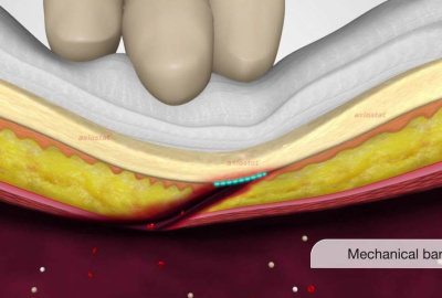 BƯỚC ĐỘT PHÁ TRONG CÔNG NGHỆ SẢN XUẤT BĂNG GẠC CẦM MÁU TỪ CHITOSAN